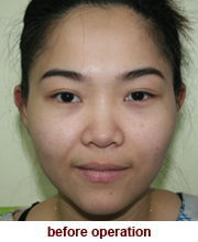 plastic_surgery_augmentation_rhinoplasty